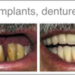 jacky-teeth-with-treatment-name