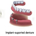 dental-care-dental-implants-abroad