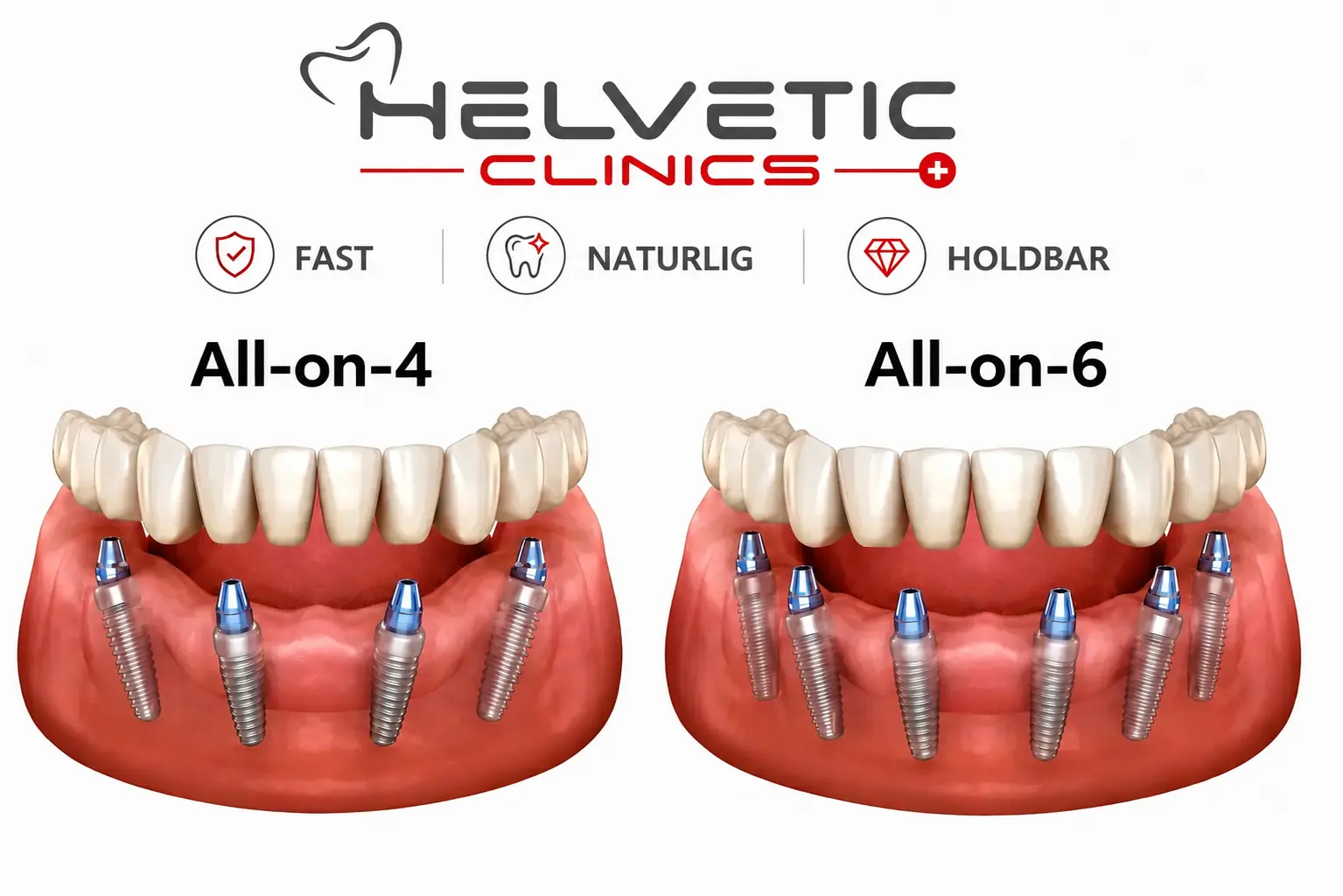Anatomisk sammenligning af All-on-4 og All-on-6 tandimplantater hos Helvetic Clinics: Visualisering af placering af 4 eller 6 tandimplantater i kæben, inklusive protetiske abutments og naturlig tandkødsrekonstruktion.