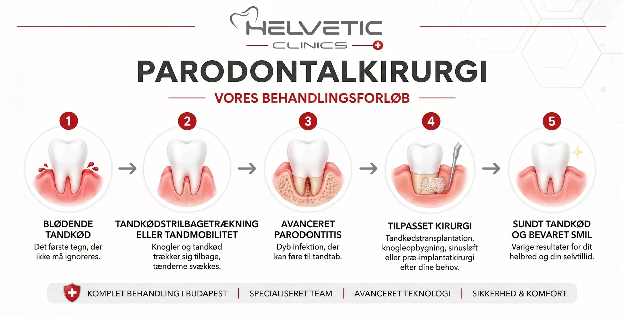 Trin-for-trin illustration af parodontose-behandling, fra blødende tandkød til sundt smil, hos Helvetic Clinics i Budapest. Viser stadier som parodontitis, knogleopbygning og tandkødsoperation.