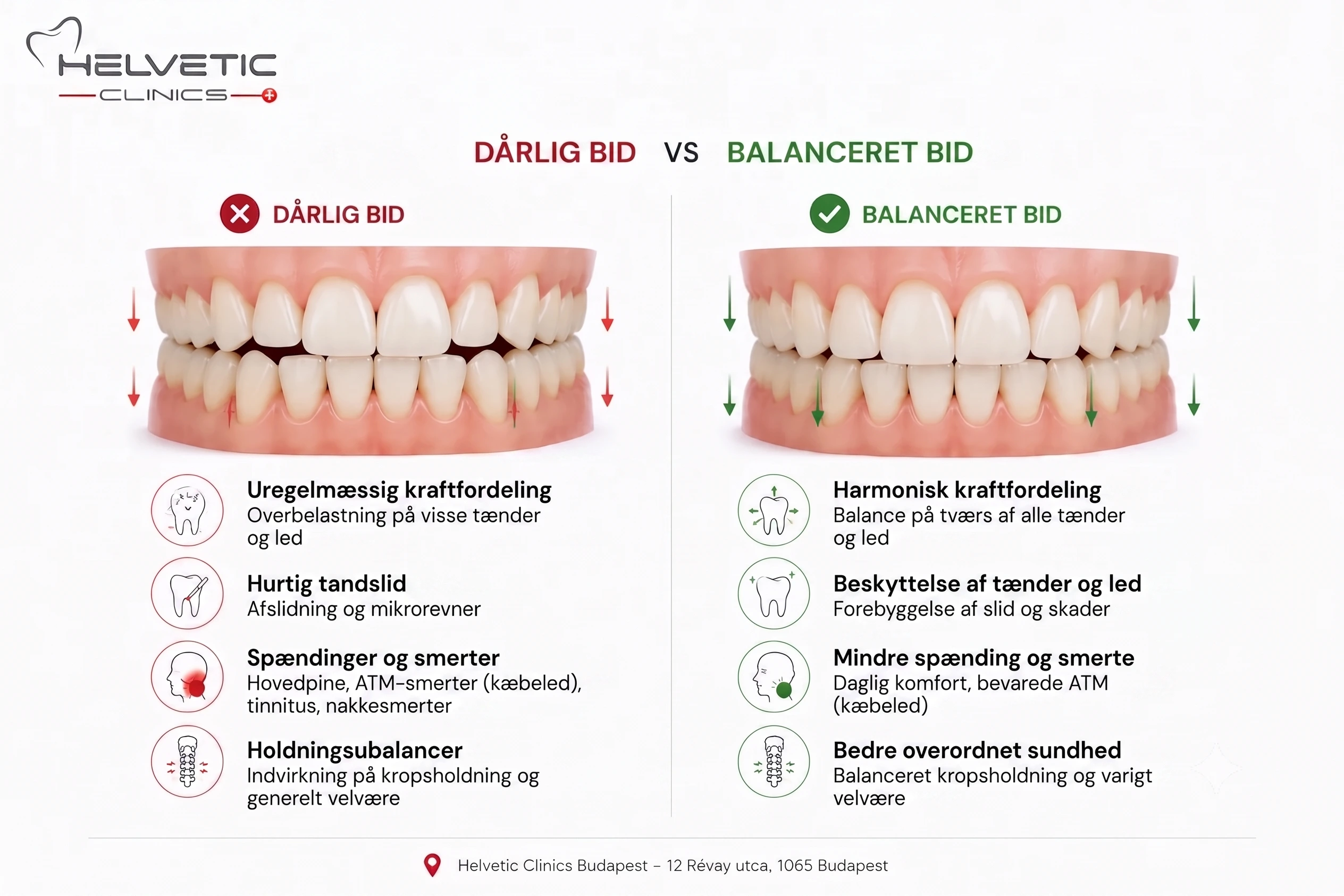 Sammenligning af malokklusion og balanceret okklusion: Illustration af kraftfordeling på tænder og kæbeled (TMJ) – Helvetic Clinics Budapest.