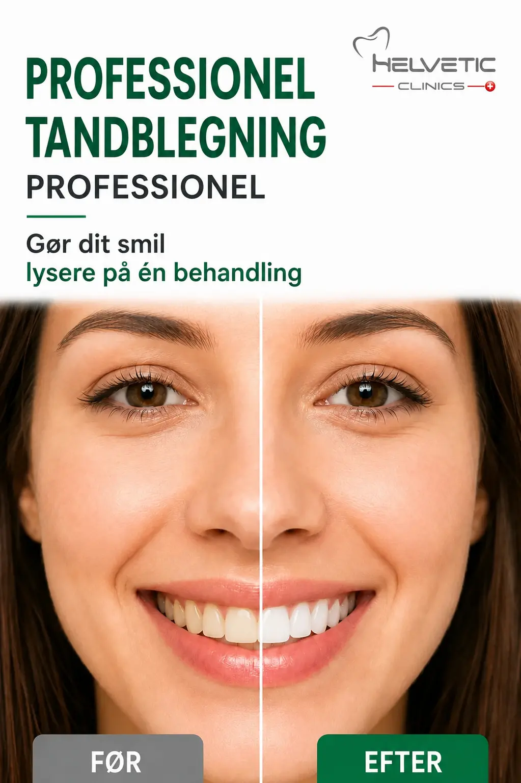 Professionel tandblegning før og efter hos Helvetic Clinics i Budapest – Resultater af kosmetisk tandbehandling.