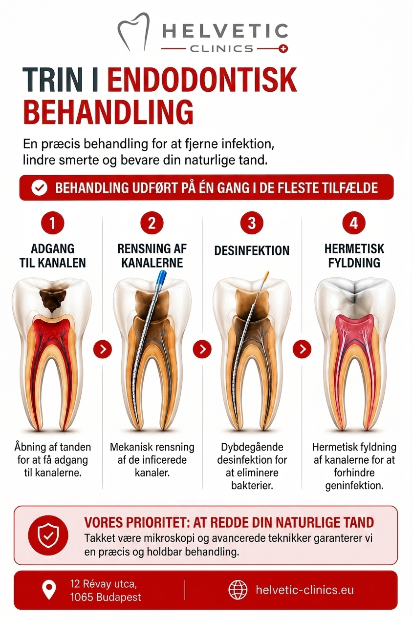 Trinene i en endodontisk behandling under mikroskop hos Helvetic Clinics Budapest: adgang til rodkanalen, grundig rensning, desinfektion og hermetisk forsegling for at bevare den naturlige tand.